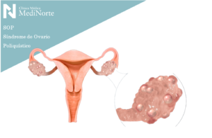 Sindrome Ovario poliquistico | sop