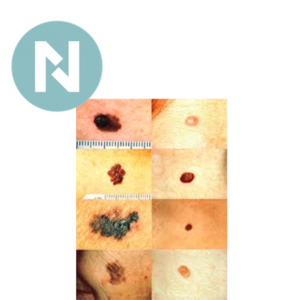 cancer de piel | prevencion cancer de piel
